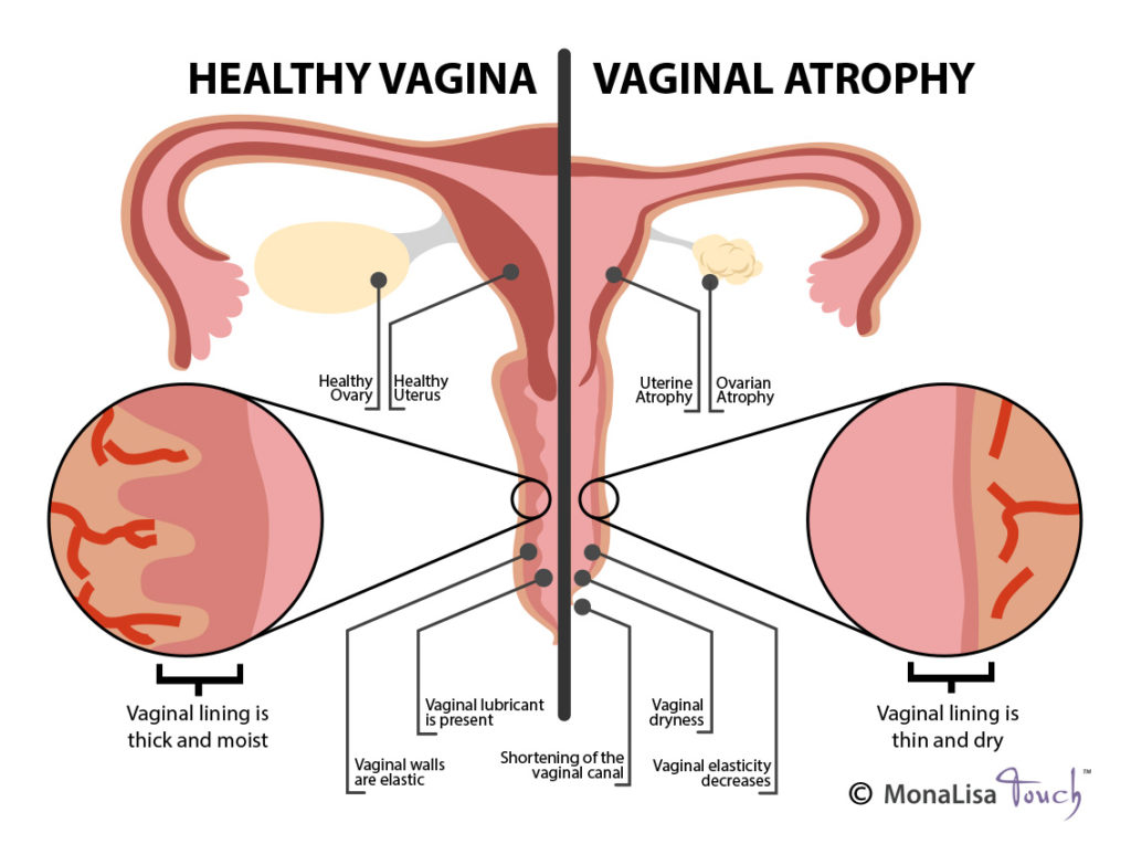 vaginal atrophy diagram